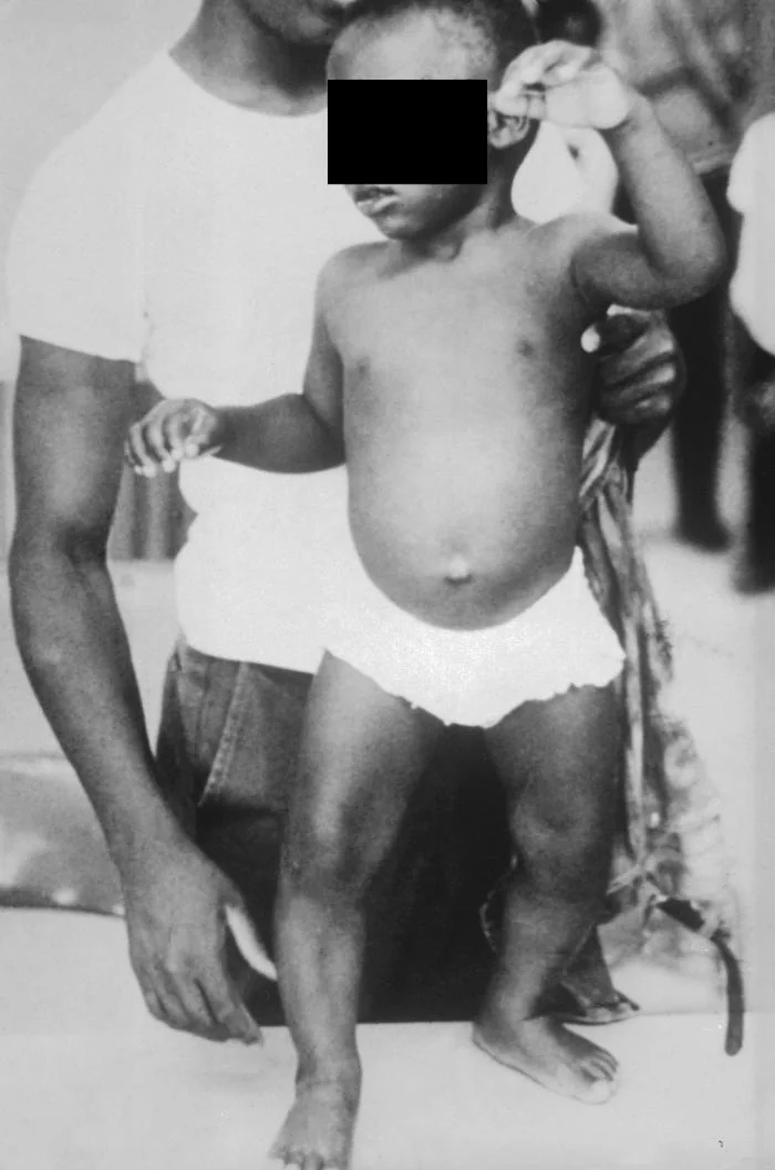 Full-length photograph of a young child standing, showing marked outward bowing of both lower legs and visible enlargement of the wrist, with a protuberant abdomen.