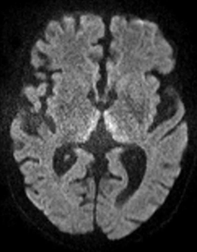 Axial diffusion-weighted MRI of the brain showing symmetrical areas of bright, restricted diffusion in the medial thalami on both sides of the third ventricle.